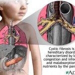 2008-04-cystic-fibrosis-graphicjpg
